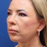 Facelift Before & After Patient #1609
