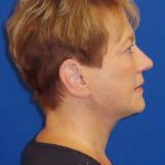 Facelift Before & After Patient #1620