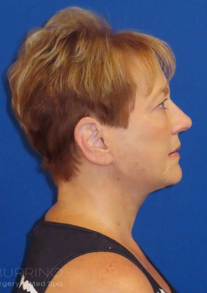 Facelift Before & After Patient #1620