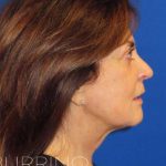 Facelift Before & After Patient #1631