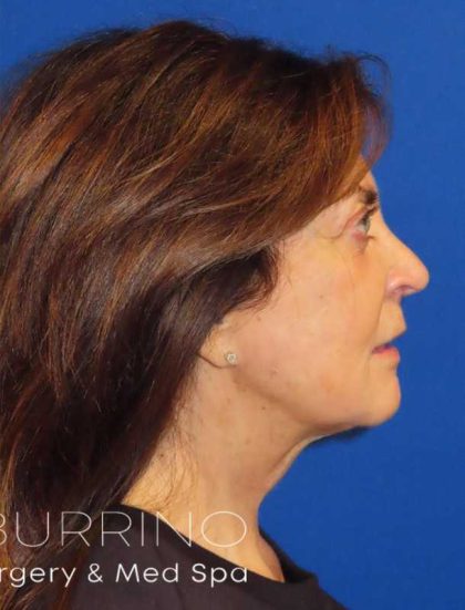 Facelift Before & After Patient #1631