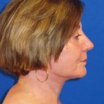 Facelift Before & After Patient #1642