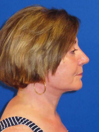 Facelift Before & After Patient #1642