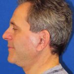 Facelift Before & After Patient #1653