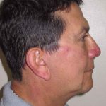 Facelift Before & After Patient #1664
