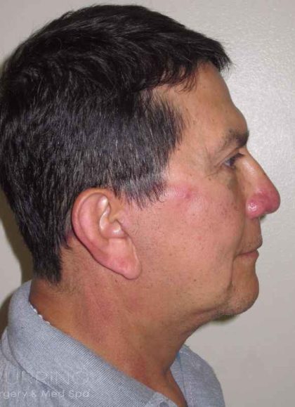 Facelift Before & After Patient #1664