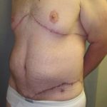 Lower Body Lift Before & After Patient #585
