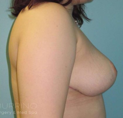 Breast Lift Before & After Patient #1926