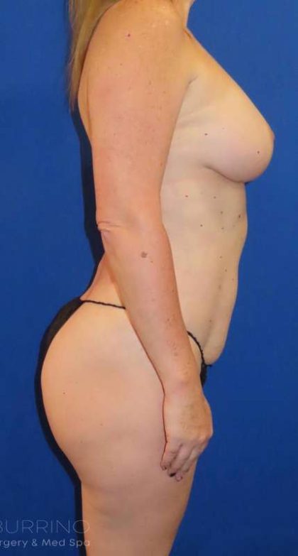 Liposuction Before & After Patient #681