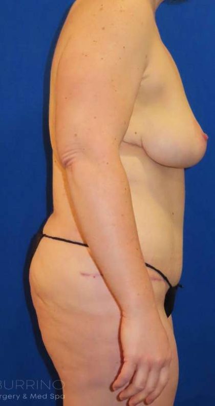 Liposuction Before & After Patient #742