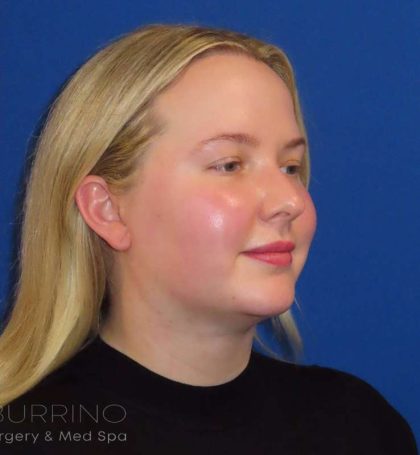 Liposuction Before & After Patient #813