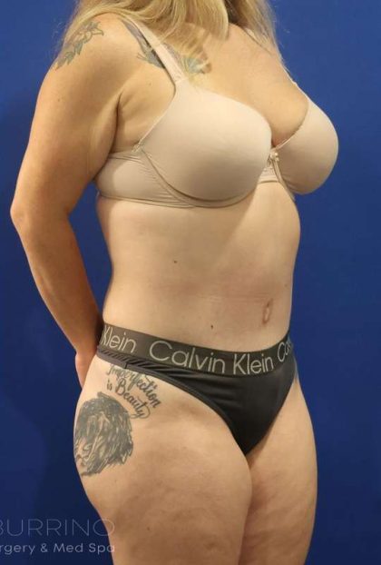 Liposuction Before & After Patient #852