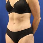 Tummy Tuck Before & After Patient #1153