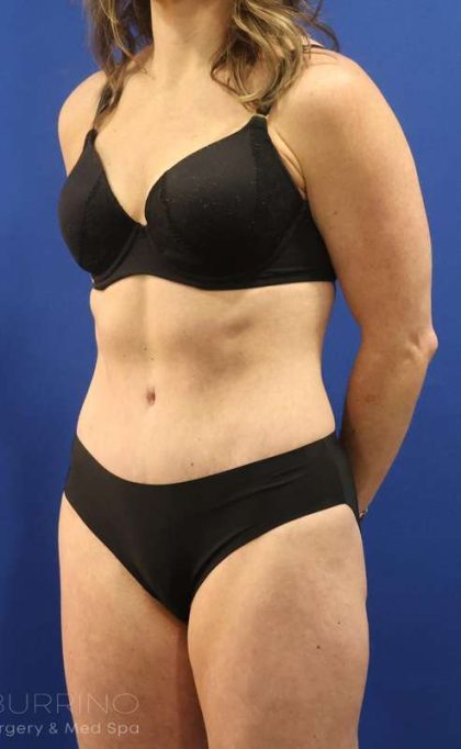 Tummy Tuck Before & After Patient #1153