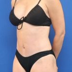 Tummy Tuck Before & After Patient #1164