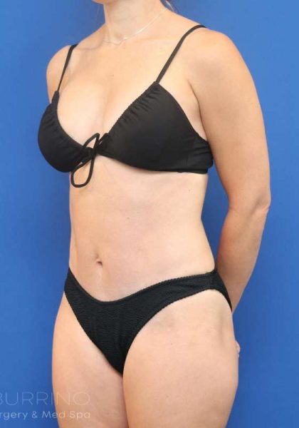 Tummy Tuck Before & After Patient #1164