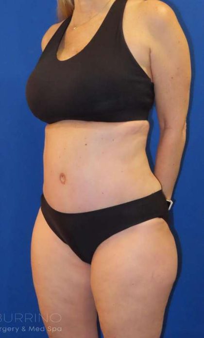 Tummy Tuck Before & After Patient #1190
