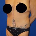 Tummy Tuck Before & After Patient #1214