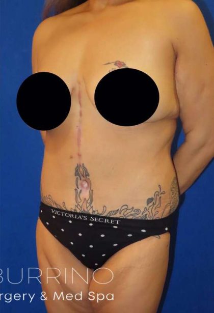 Tummy Tuck Before & After Patient #1214