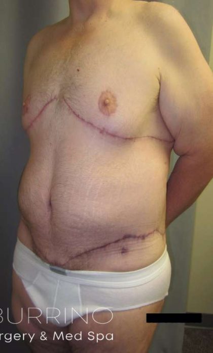 Tummy Tuck Before & After Patient #1225