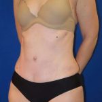 Tummy Tuck Before & After Patient #1236