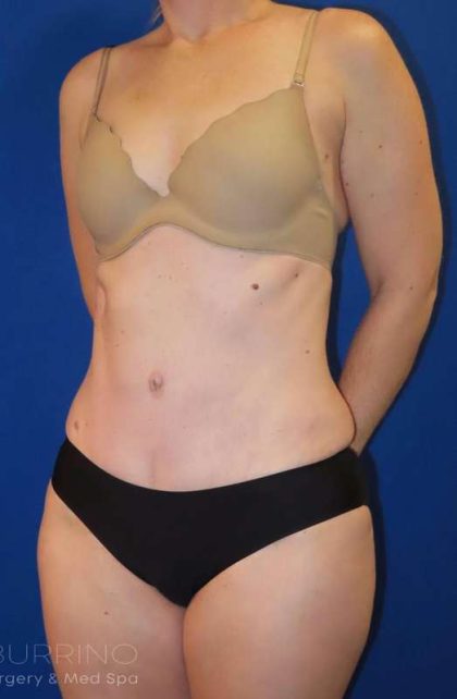 Tummy Tuck Before & After Patient #1236