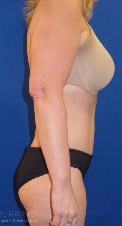 Tummy Tuck Before & After Patient #1273