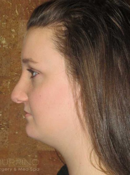 Rhinoplasty Before & After Patient #1406