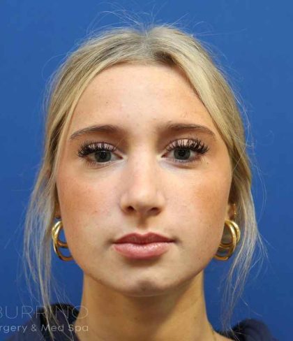 Rhinoplasty Before & After Patient #1415