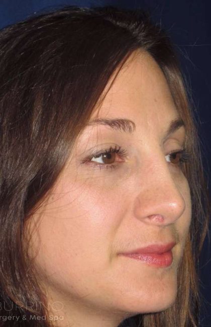 Rhinoplasty Before & After Patient #1424