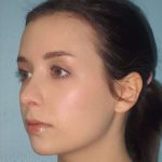 Rhinoplasty Before & After Patient #1439