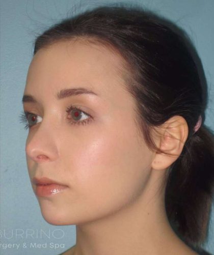 Rhinoplasty Before & After Patient #1439