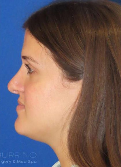 Rhinoplasty Before & After Patient #1454