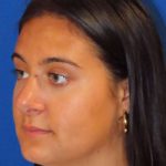 Rhinoplasty Before & After Patient #1465