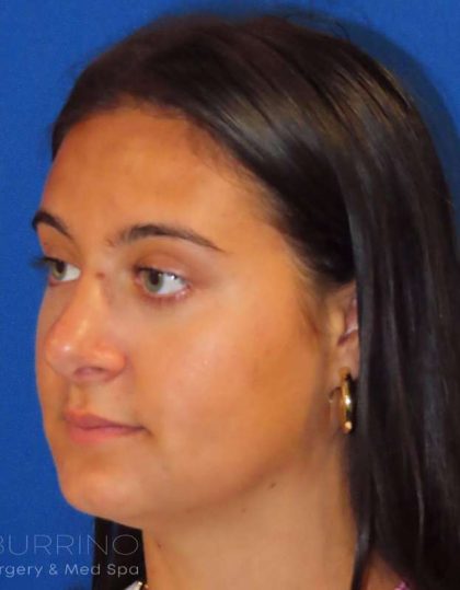 Rhinoplasty Before & After Patient #1465