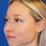 Rhinoplasty Before & After Patient #1476