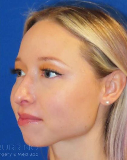 Rhinoplasty Before & After Patient #1476