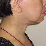 Neck Lift Before & After Patient #1498