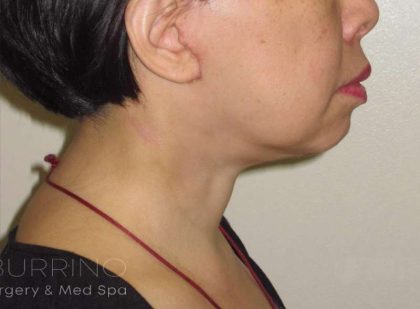 Neck Lift Before & After Patient #1498
