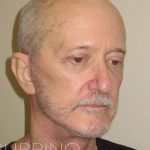 Neck Lift Before & After Patient #1509
