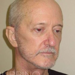 Neck Lift Before & After Patient #1509