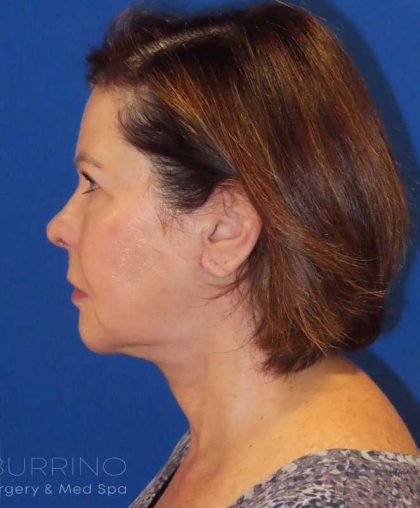 Neck Lift Before & After Patient #1578
