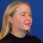 Neck Lift Before & After Patient #1589