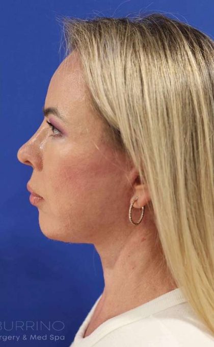 Facelift Before & After Patient #1609