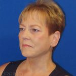 Facelift Before & After Patient #1620