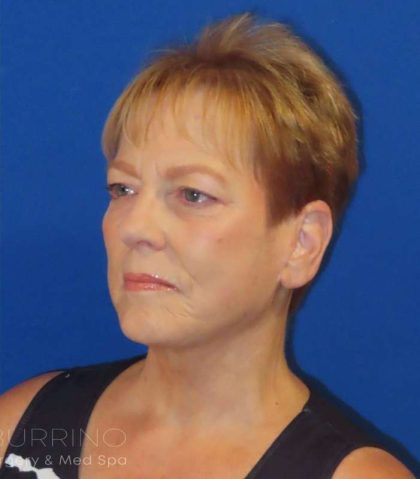 Facelift Before & After Patient #1620