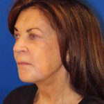 Facelift Before & After Patient #1631