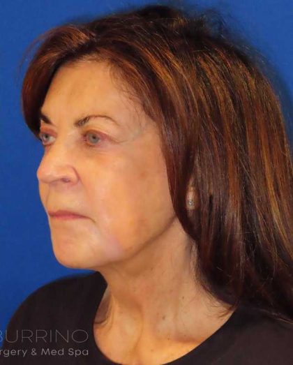 Facelift Before & After Patient #1631