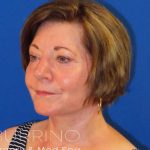 Facelift Before & After Patient #1642
