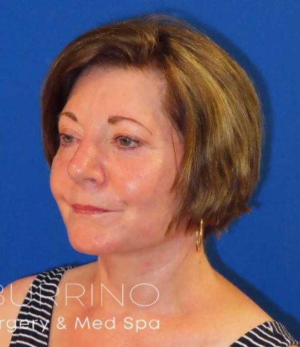 Facelift Before & After Patient #1642